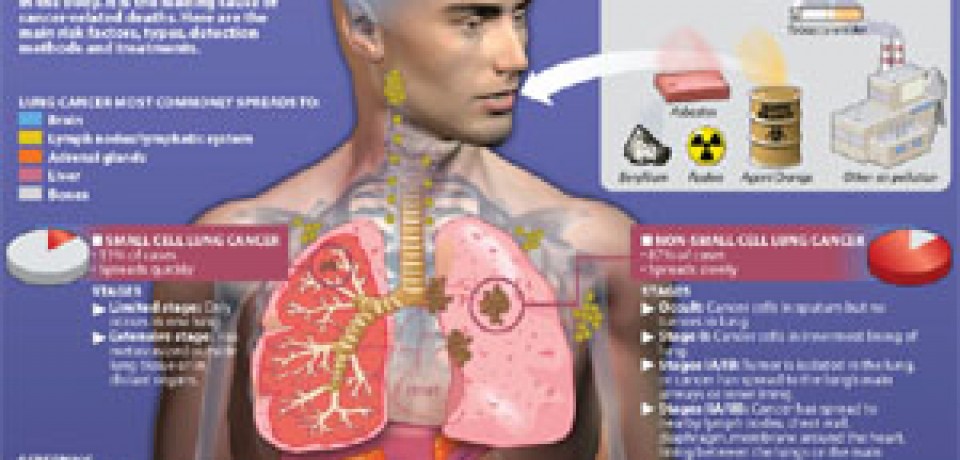 Causes of Lung Cancer